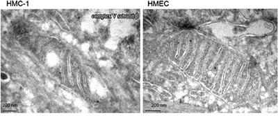 Consideration of Ketogenic Metabolic Therapy as a Complementary or Alternative Approach for Managing Breast Cancer